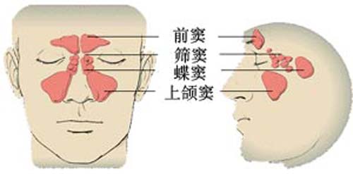 副鼻窦炎是什么 副鼻窦炎是什么症状及治疗