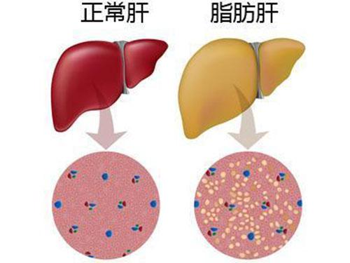 脂肪肝怎么调理（脂肪肝怎么调理吃什么药）