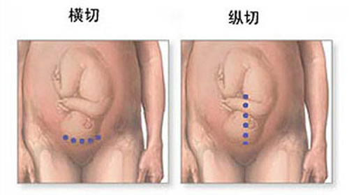 剖腹产横切还是竖切好 剖腹产是横切好还是竖切