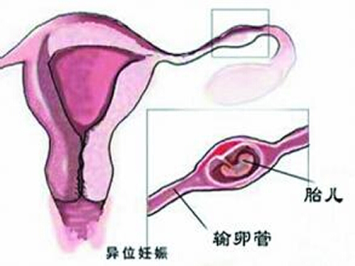 宫外孕是怎么引起的 宫角妊娠是什么原因引起的