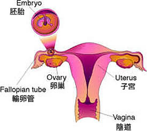 什么是宫外孕 什么是宫外孕症状早期