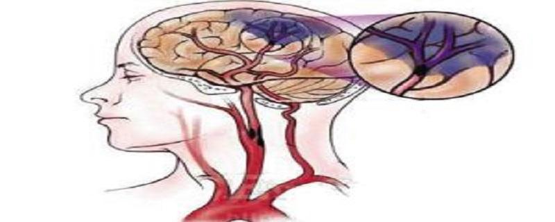 脑梗死是什么病 脑梗死是什么病严重吗
