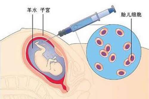 羊水穿刺什么时候做 羊水穿刺什么时候做比较好