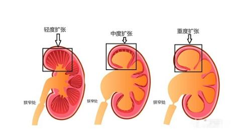 肾积水有哪些症状（儿童肾积水有哪些症状）