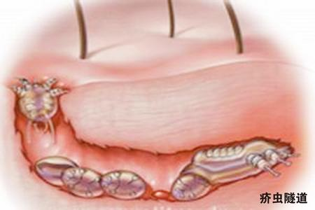 疥瘡是怎么引起的（手上長疥瘡是怎么引起的）