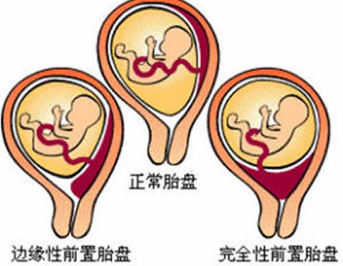 前置胎盘是怎样造成的（前置胎盘是怎么造成的）