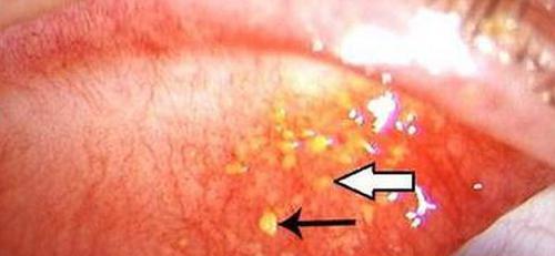 上眼皮里面长了个小白点是怎么回事 上眼皮里面长了个小白点怎么办