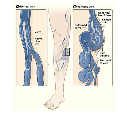 下肢静脉曲张有什么危害 下肢静脉曲张有什么危害性