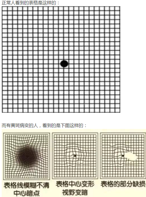 眼睛看东西变形扭曲是什么原因 眼睛看东西变形扭曲是什么原因用什么药