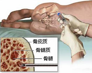 解惑：骨髓捐獻(xiàn)5大擔(dān)憂 捐獻(xiàn)骨髓有多痛苦