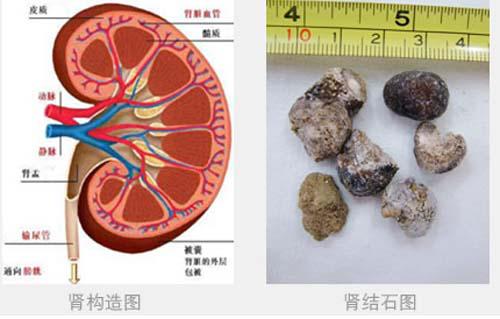 肾结石需要做手术吗（1.5厘米的肾结石需要做手术吗）