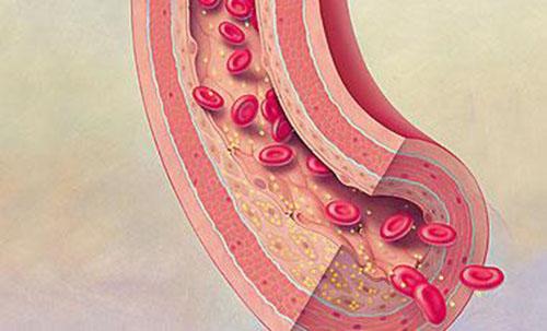 早期血栓癥狀有哪些 早期血栓的癥狀有哪些