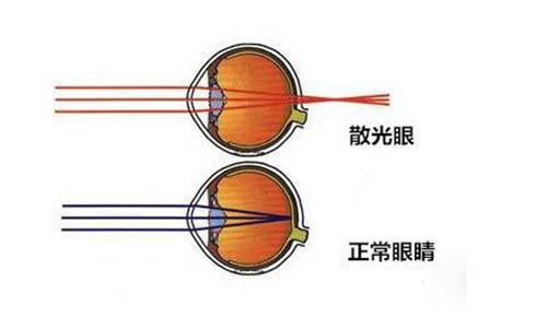 散光的原因 散光眼的治療方法