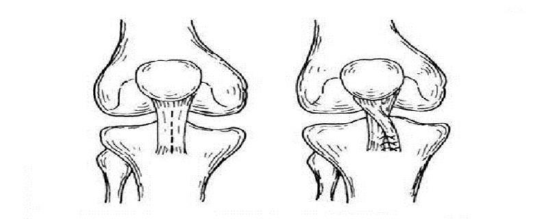 髌骨半脱位的原因 髌骨半脱位的原因及治疗