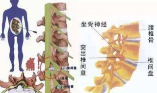 腰间盘突出怎么冶 腰间盘突出治疗的两个方法