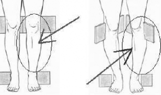 o型腿怎么办 怎么矫正O型腿