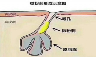 如何有效應(yīng)對(duì)毛孔堵塞（怎么樣才能解決毛孔堵塞）