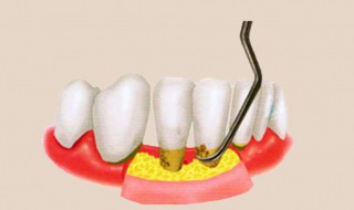 快速去除牙结石最好方法 快速去除牙结石最好方法是什么
