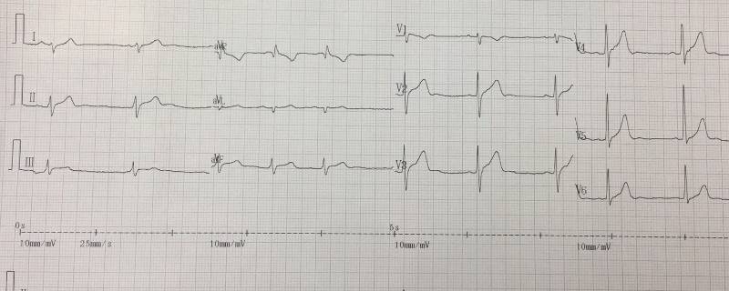 心电图怎么看 心电图怎么看左心室高电压