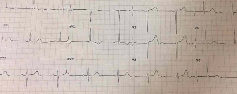 t波改变是什么意思？（窦性心律t波改变是什么意思）