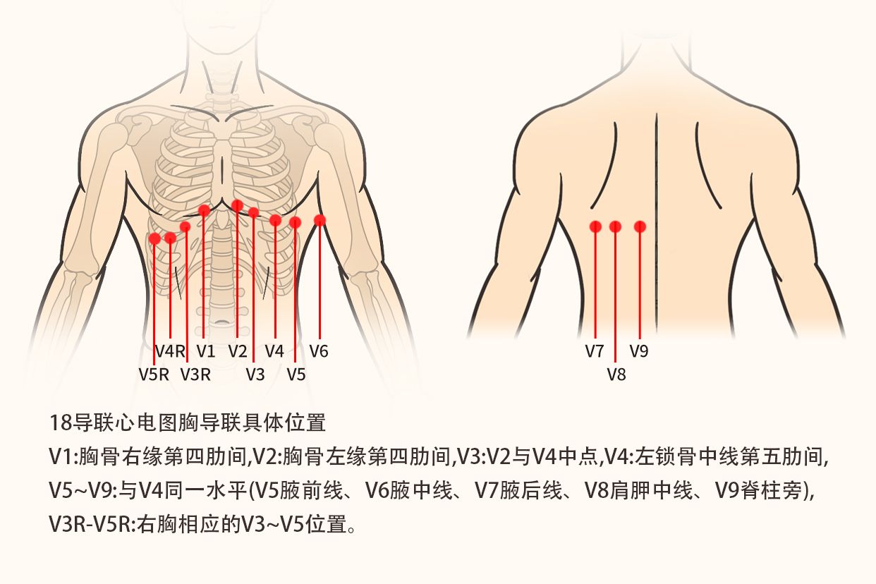 18導(dǎo)心電圖連接示意圖（心電圖18導(dǎo)聯(lián)連接部位圖解）