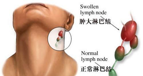 淋巴結(jié)腫大的偏方（治療淋巴結(jié)腫大的偏方）