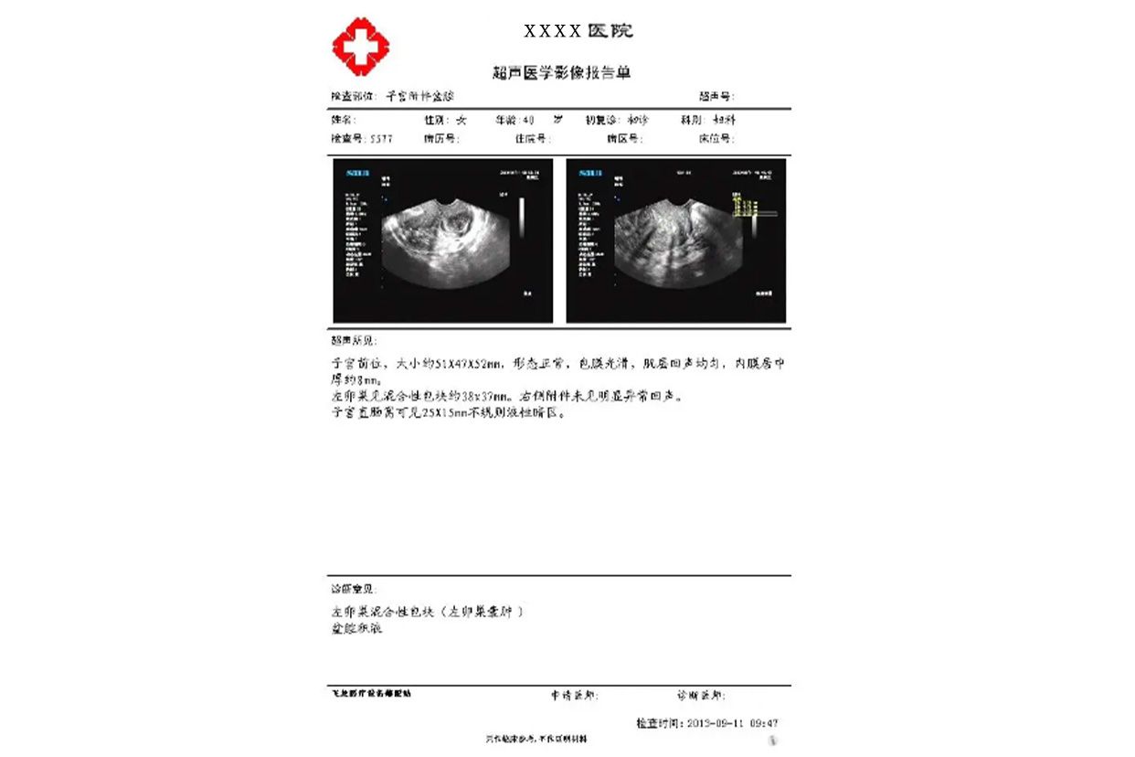 卵巢囊肿诊断证明图片 卵巢囊肿诊断证明图片高清