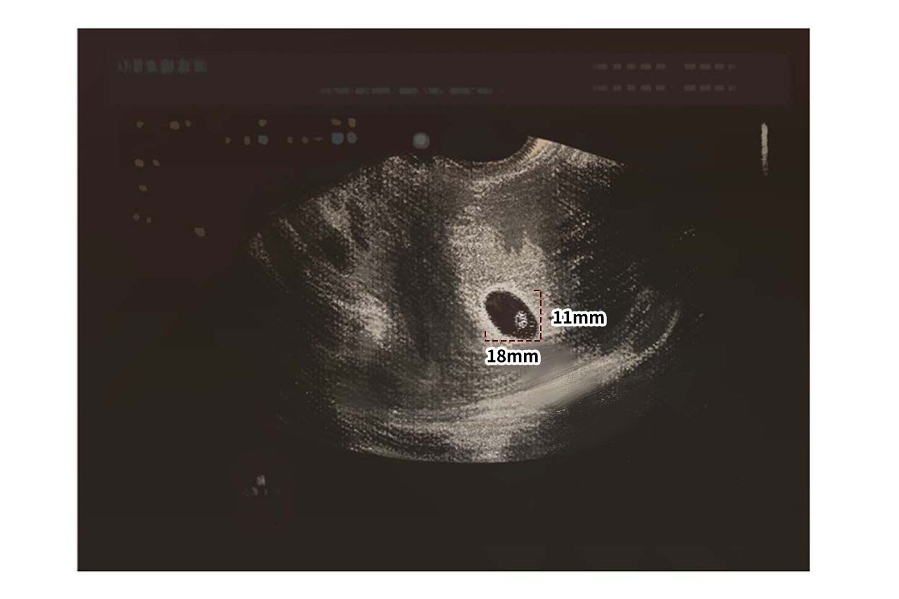 孕囊18x11圖片（孕囊20x11）