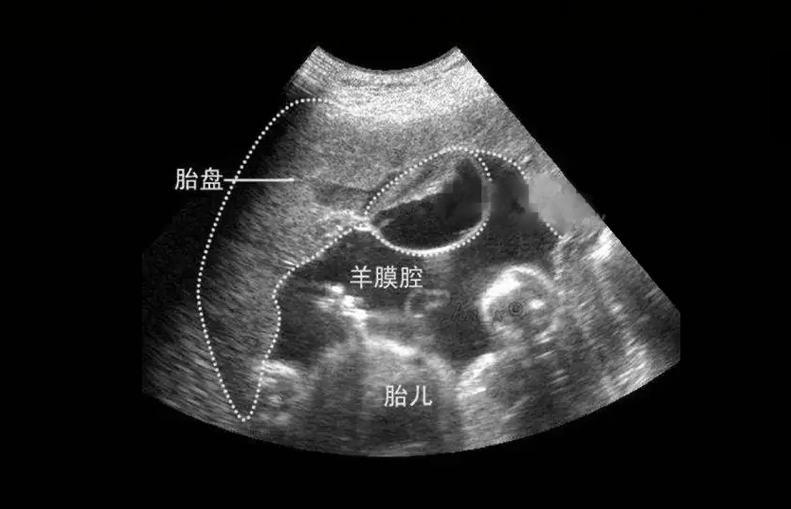 孕12周胎盘图（孕12周 胎盘）