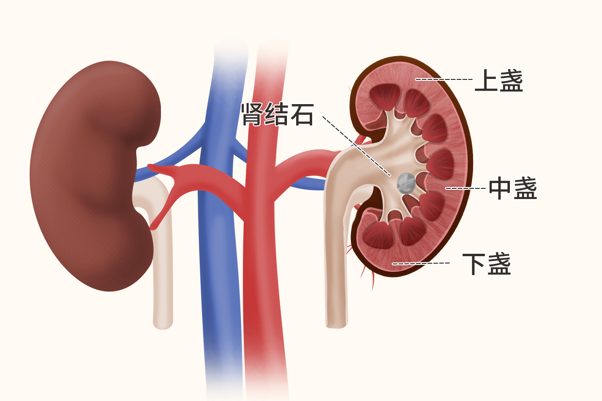 肾中下盏结石图片 肾结石在中下盏