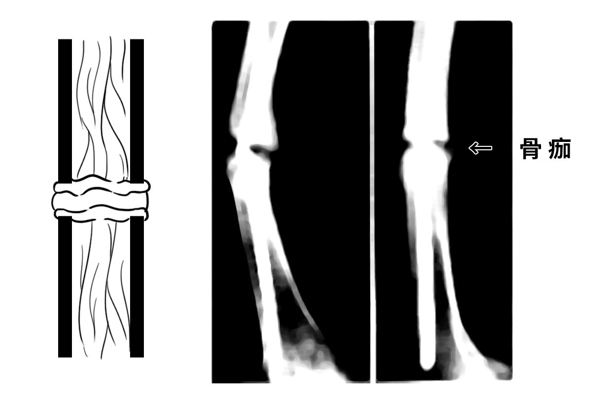 骨痂初期图片