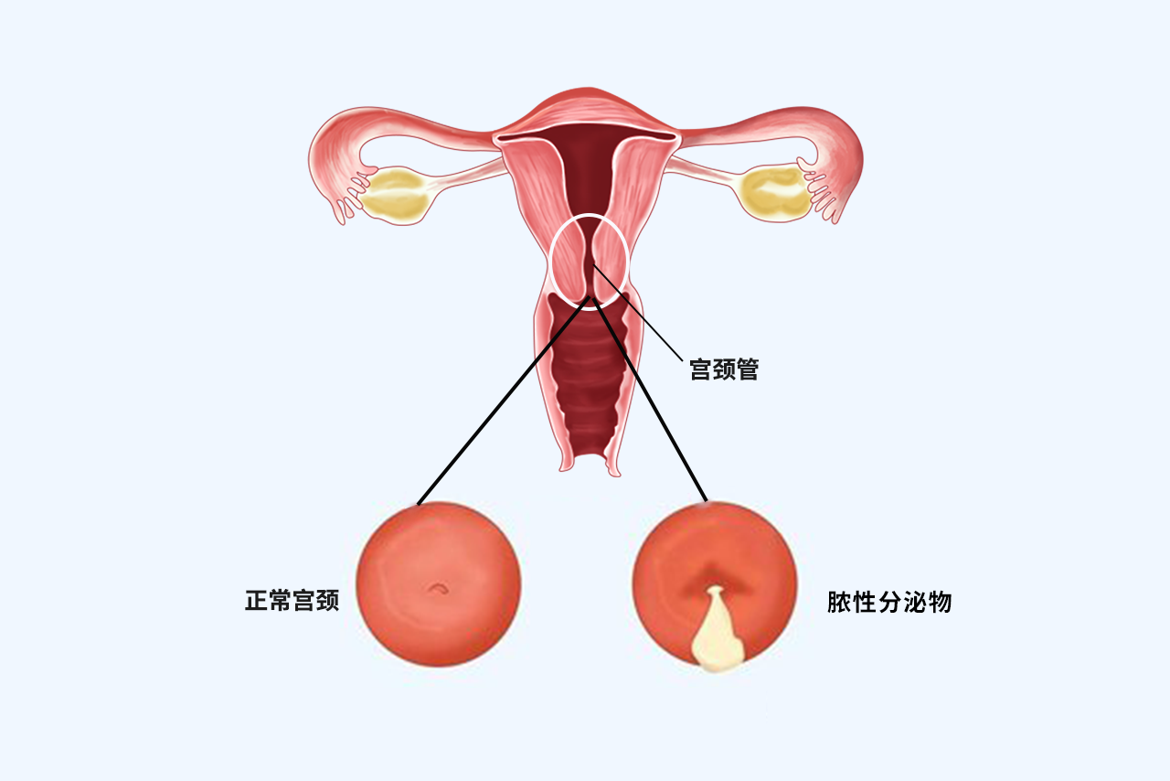 宮頸管內(nèi)膜炎圖片