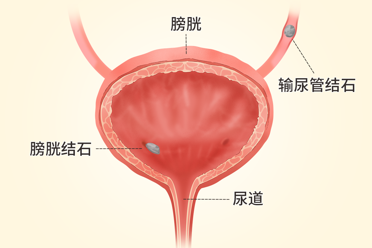 男生膀胱結(jié)石在什么位置圖片