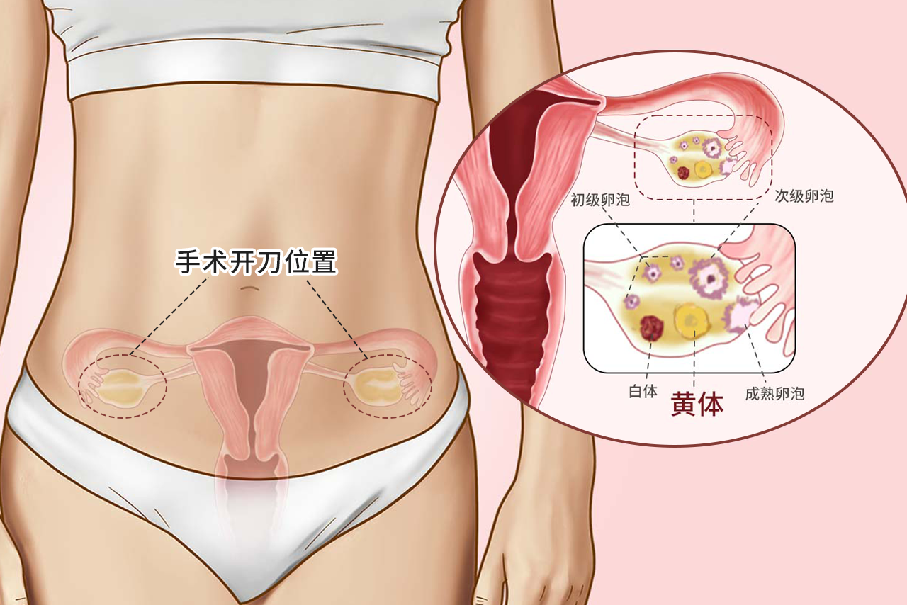 黃體破裂開刀位置圖片