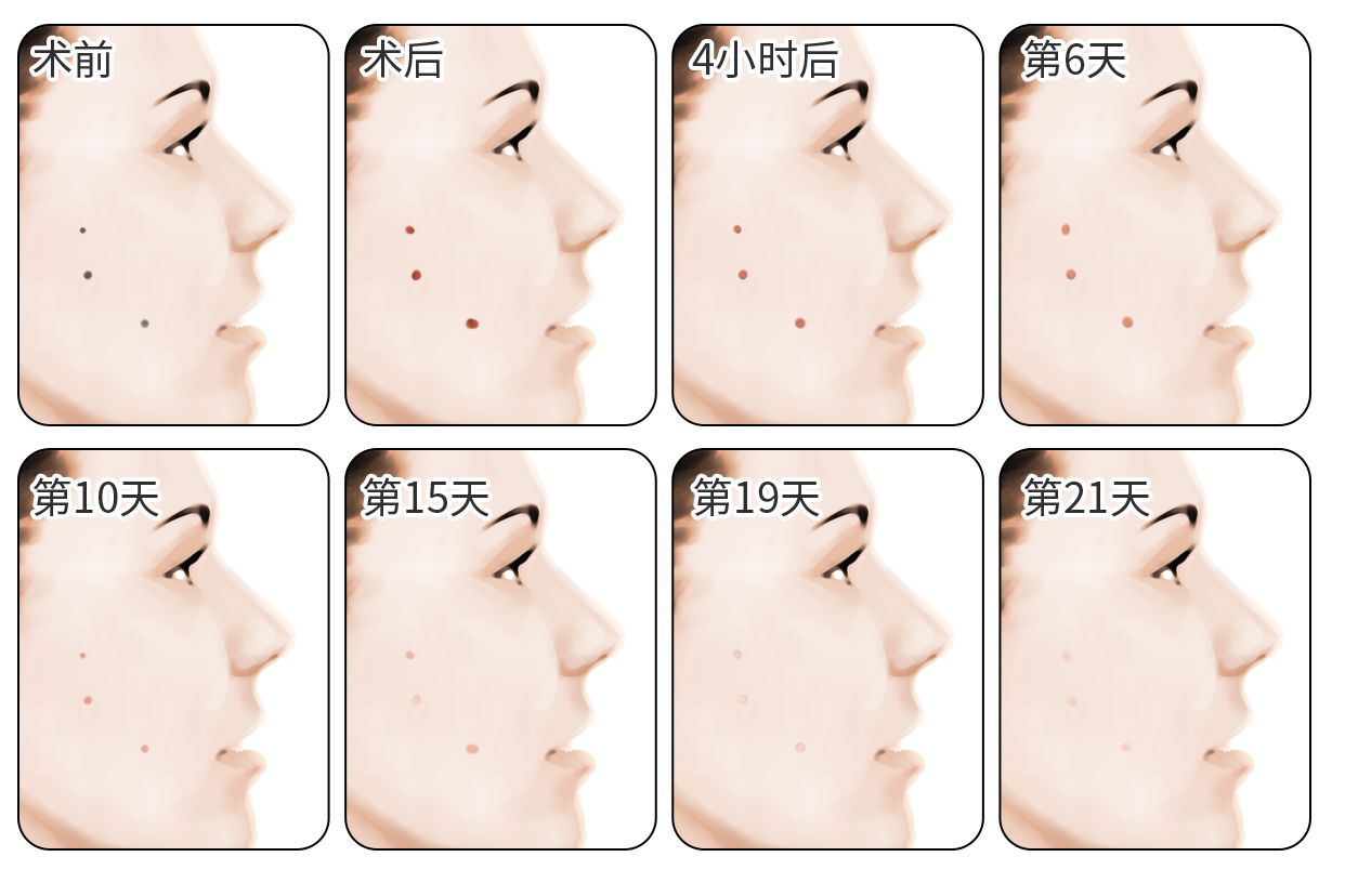 点痣1到7天图