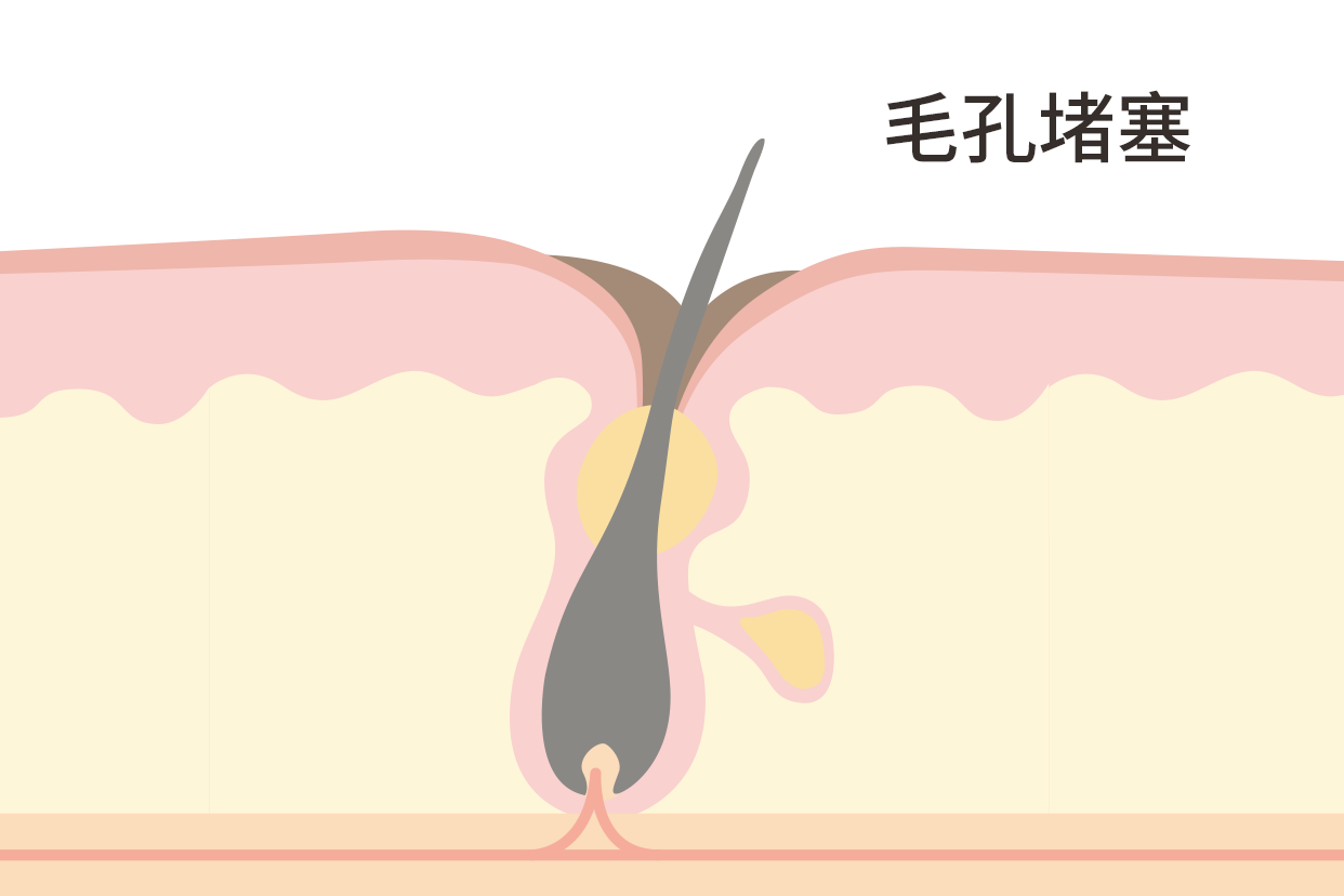 毛孔堵塞图片