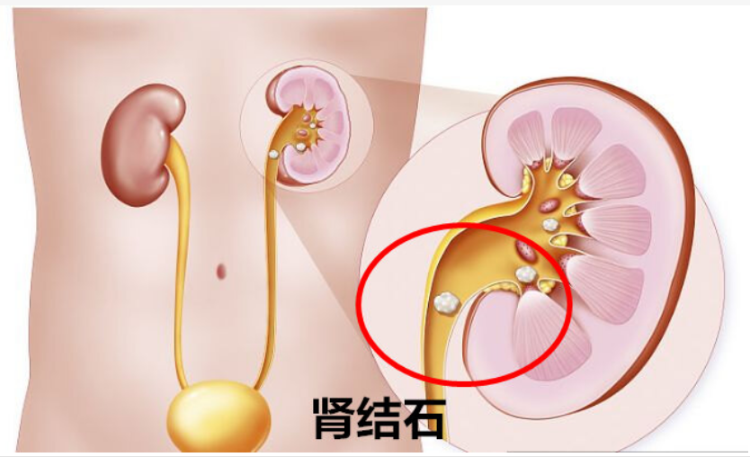 腎結(jié)節(jié)圖片