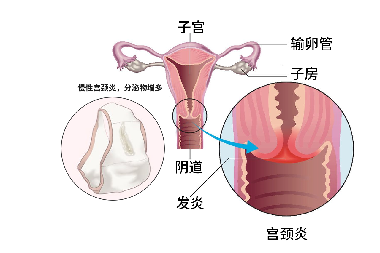 慢性宮頸炎內(nèi)褲的圖片