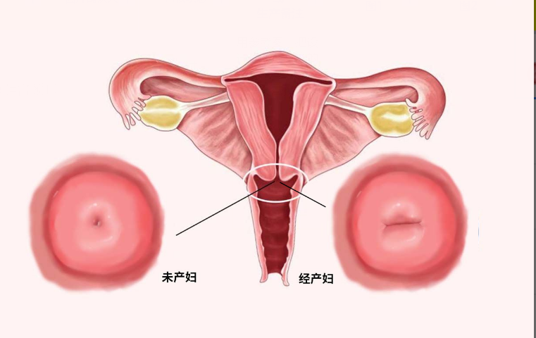 經(jīng)產(chǎn)婦和初產(chǎn)婦宮頸口區(qū)別圖片