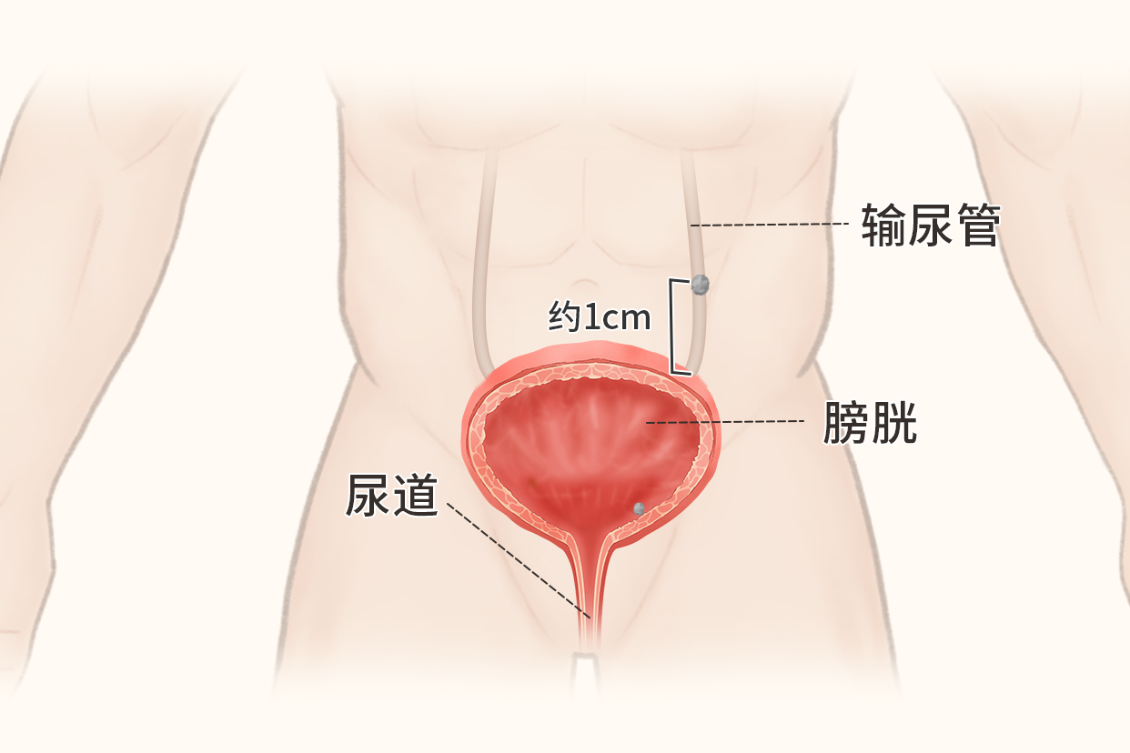 輸尿管結(jié)石到膀胱1cm距離,1cm距離是什么樣子圖