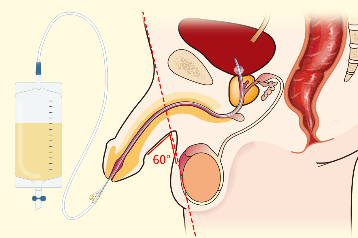 男性導(dǎo)尿什么時候與腹壁60度圖片
