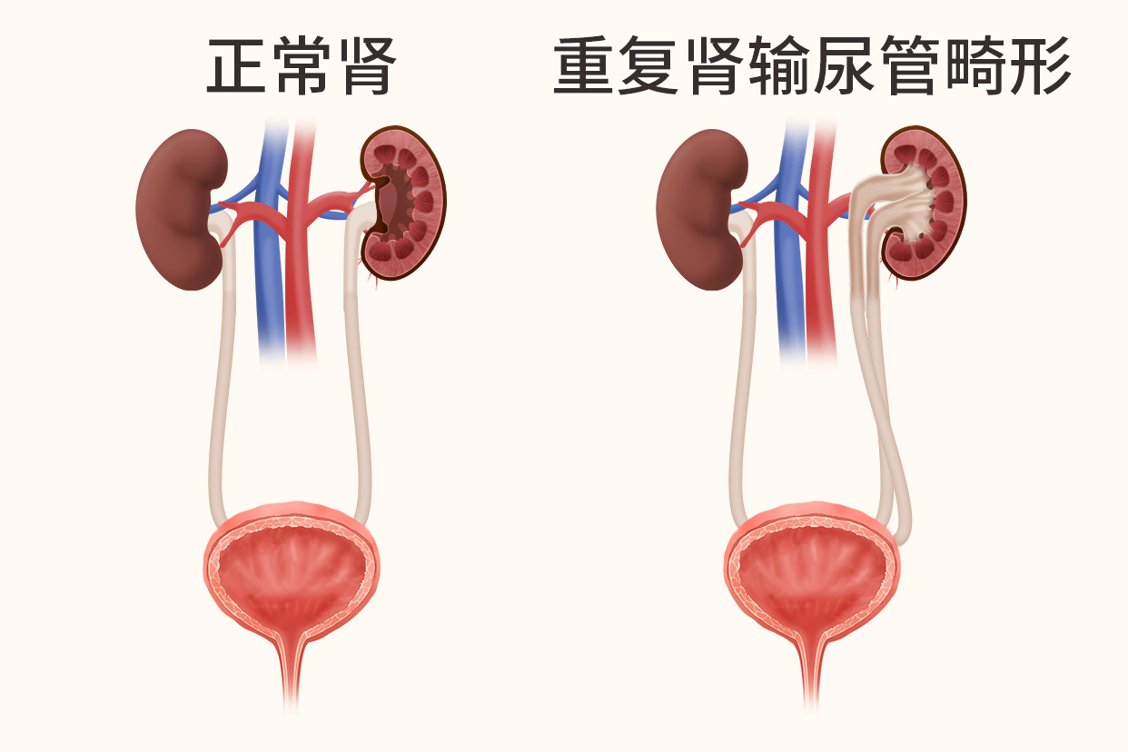 雙腎雙輸尿管圖片