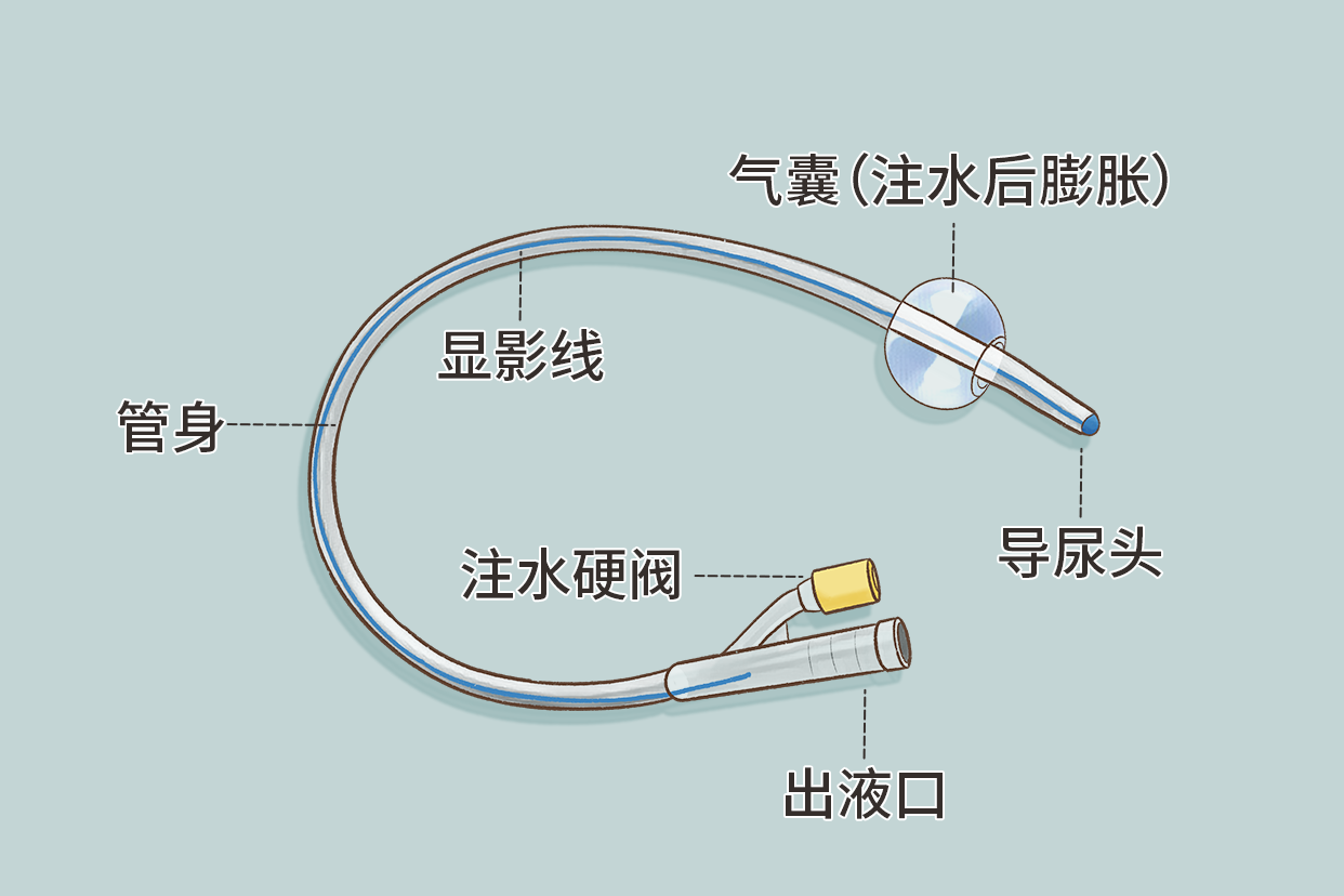 膀胱造瘺引流導(dǎo)尿管的圖片