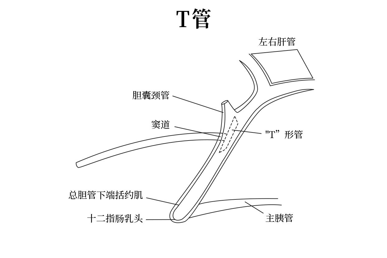 t管拔出后竇道形成圖