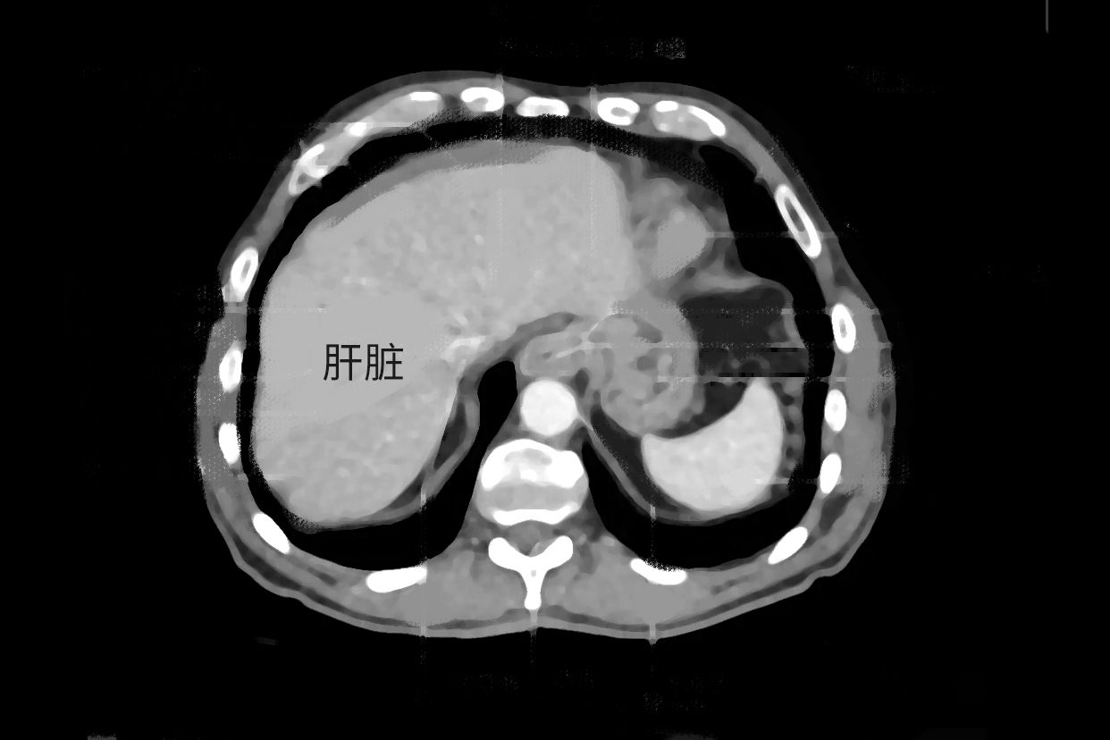 上腹部ct解剖圖