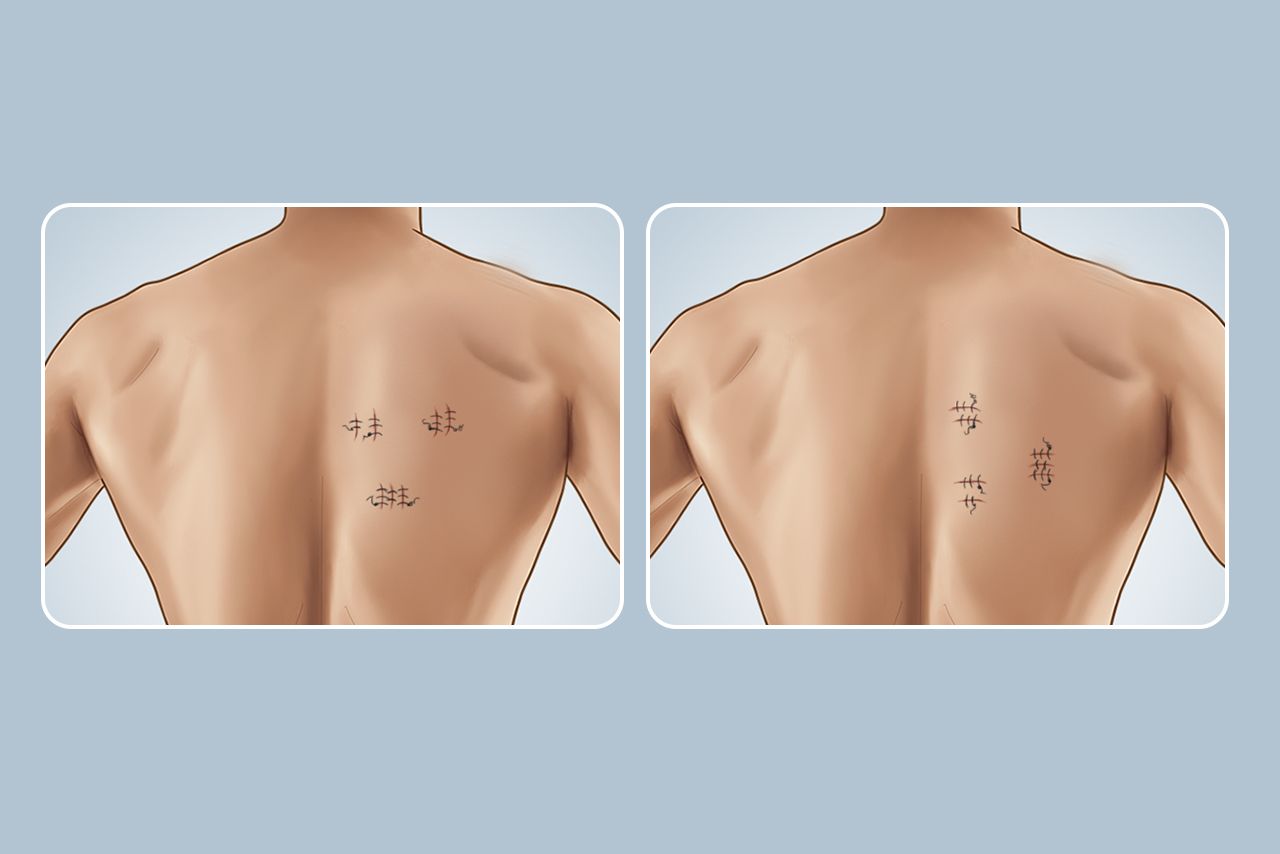背部手術(shù)切口方向圖片
