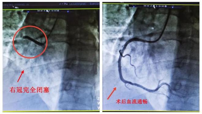 陽性一個(gè)月后，風(fēng)險(xiǎn)增加33倍！這些同時(shí)就醫(yī)的肺梗心?；颊撸苟己统龊姑撍嘘P(guān)