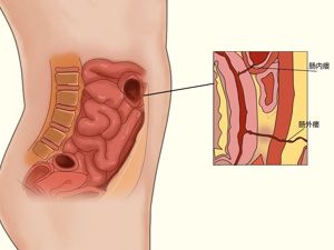 内瘘示意图 内瘘检查图片