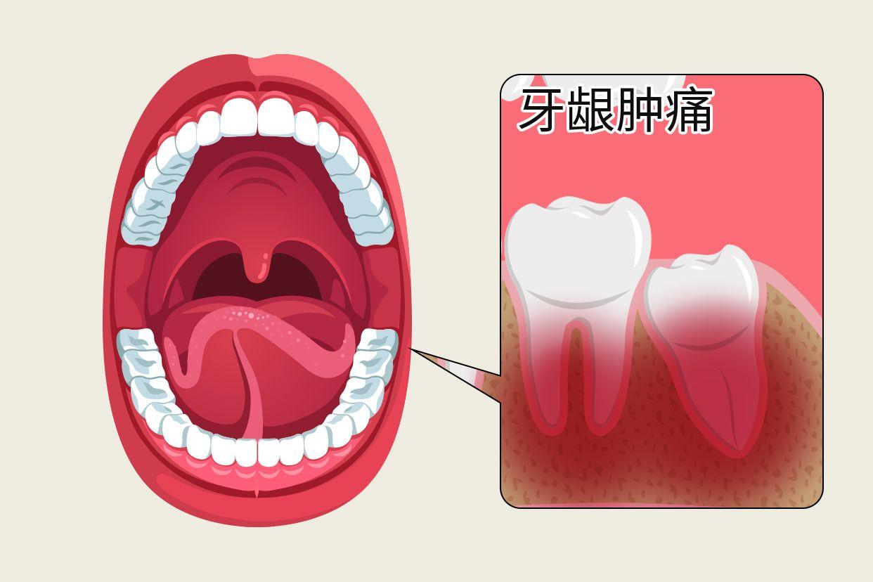最里面的牙龈肿痛图片 最里面大牙旁边肉肿了怎么办