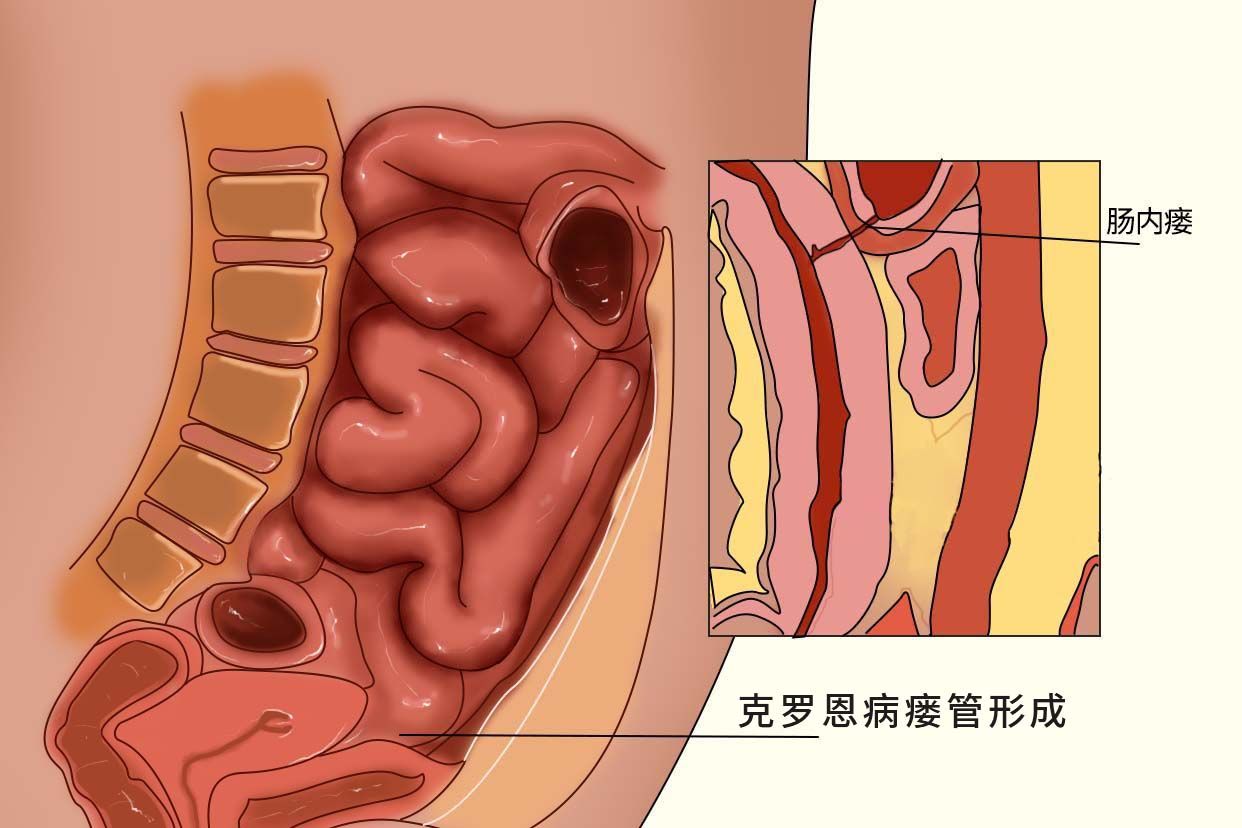 克罗恩病瘘管形成图片 克罗恩病内瘘是什么意思